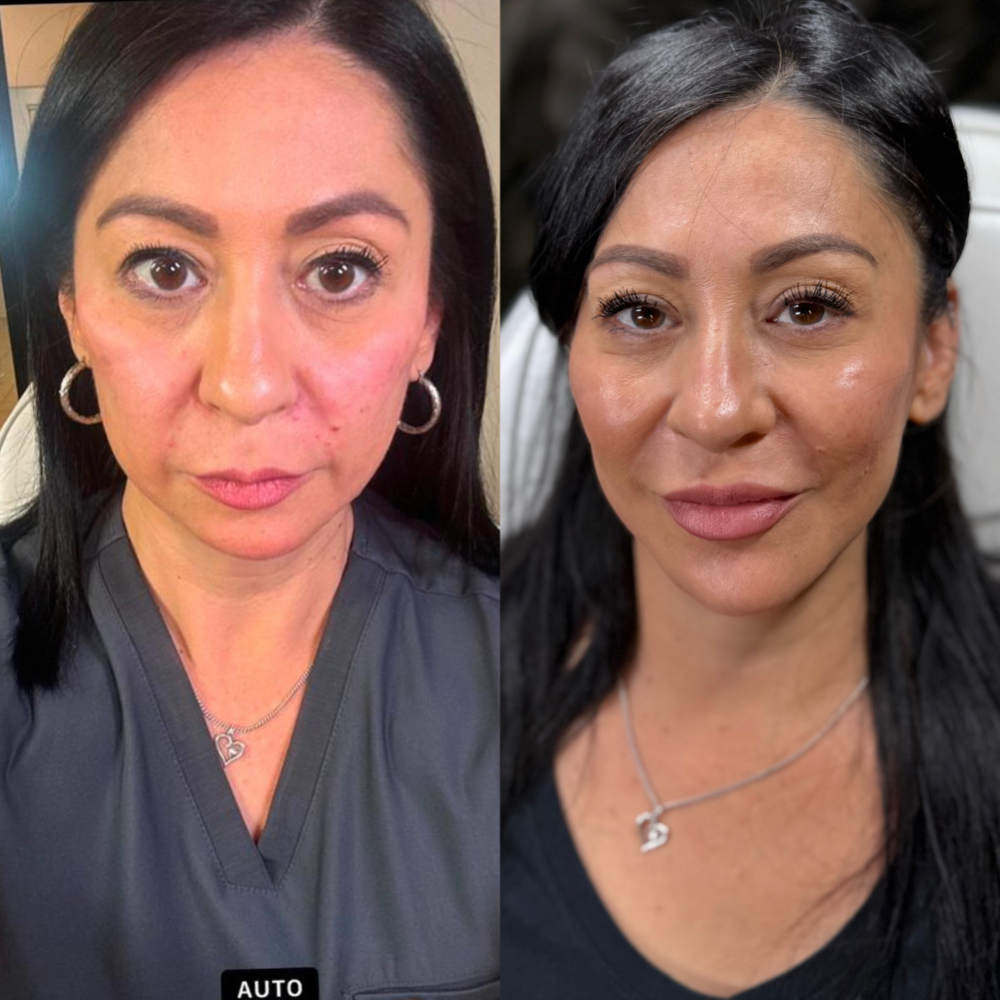 5 Syringes Facial Balancing