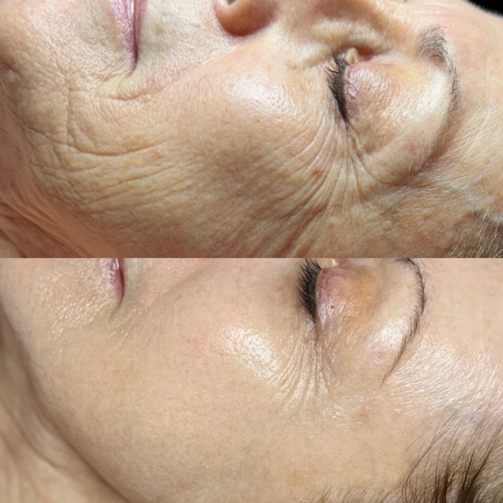 REWIND Series Of 6 (12 Treatments) at FB Skin & Wellness in Fernandina Beach, FL