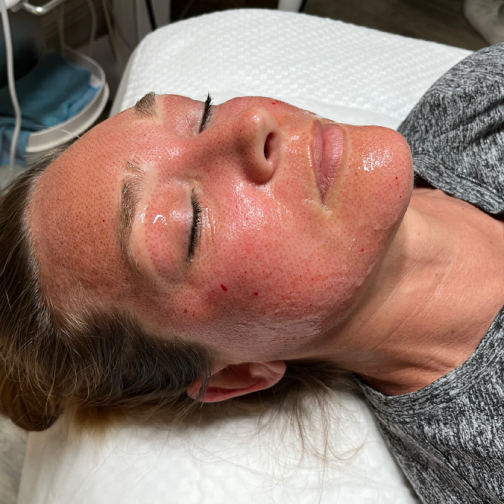 Non-Surgical Face Lift Plasma at Makeup N Giggles in Key West, FL