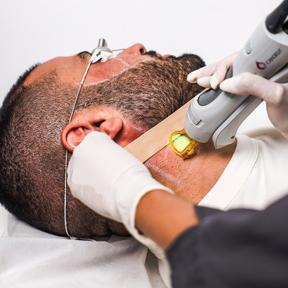 Laser Hair Removal - MEN HALF UPPER at SKIN + BODY Aesthetics in Troy, MI