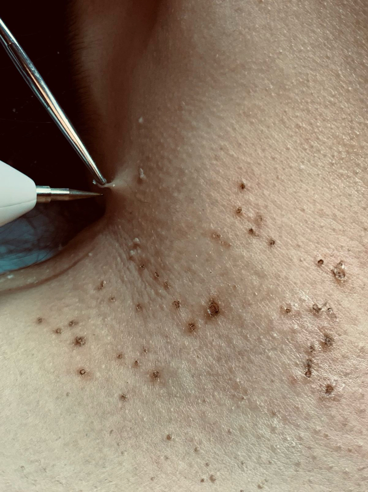 skin tag removal