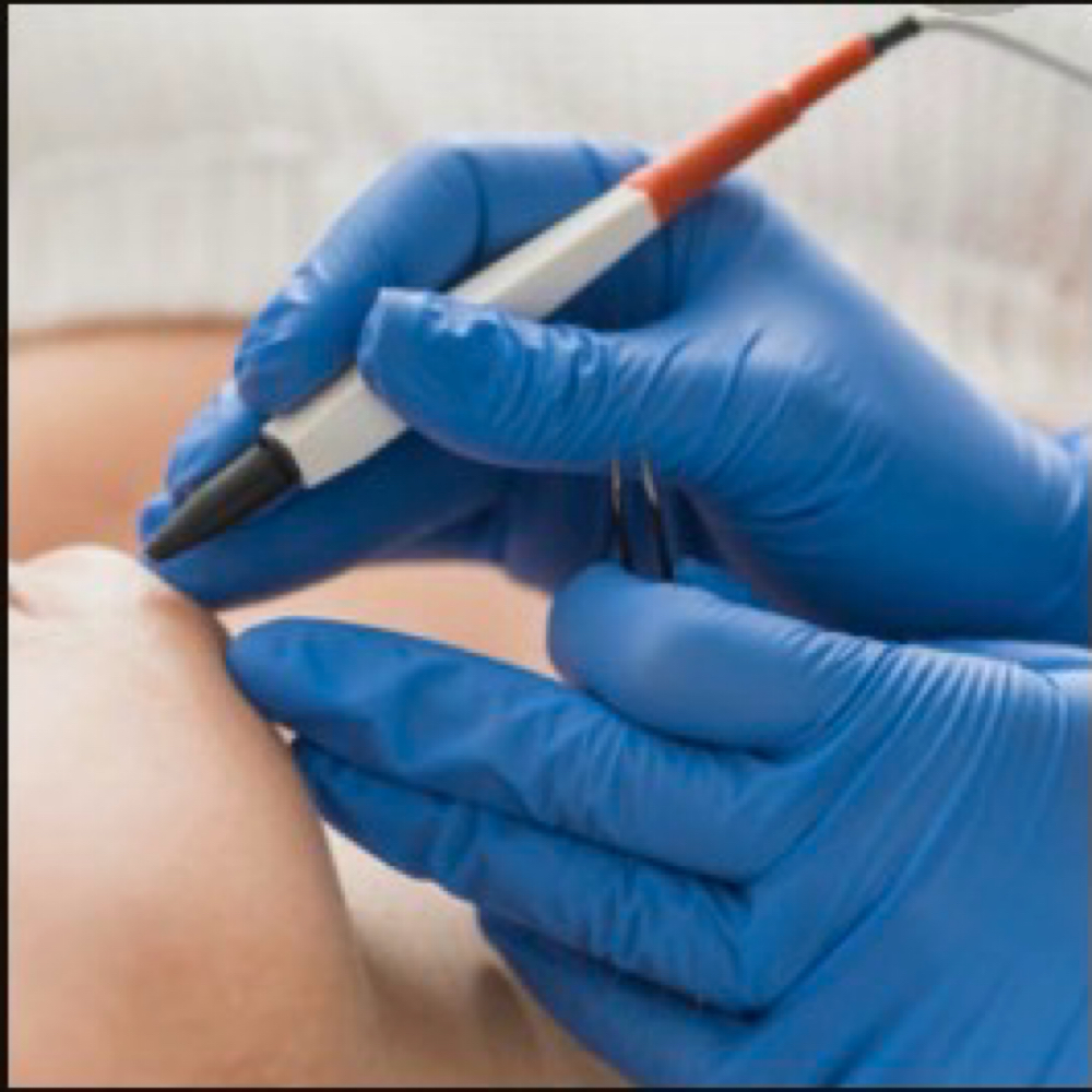 Electrolysis 2 Hours at Skin Couture in Chicago, IL