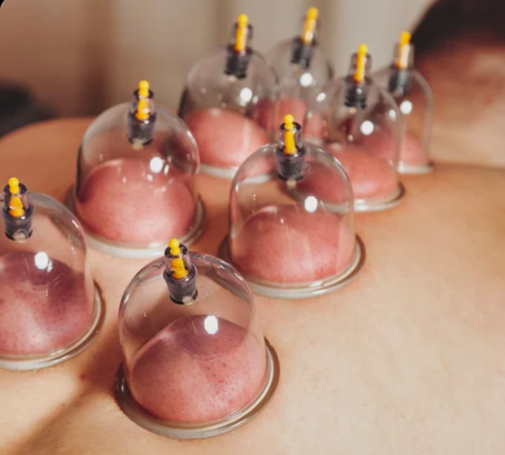 CUPPING