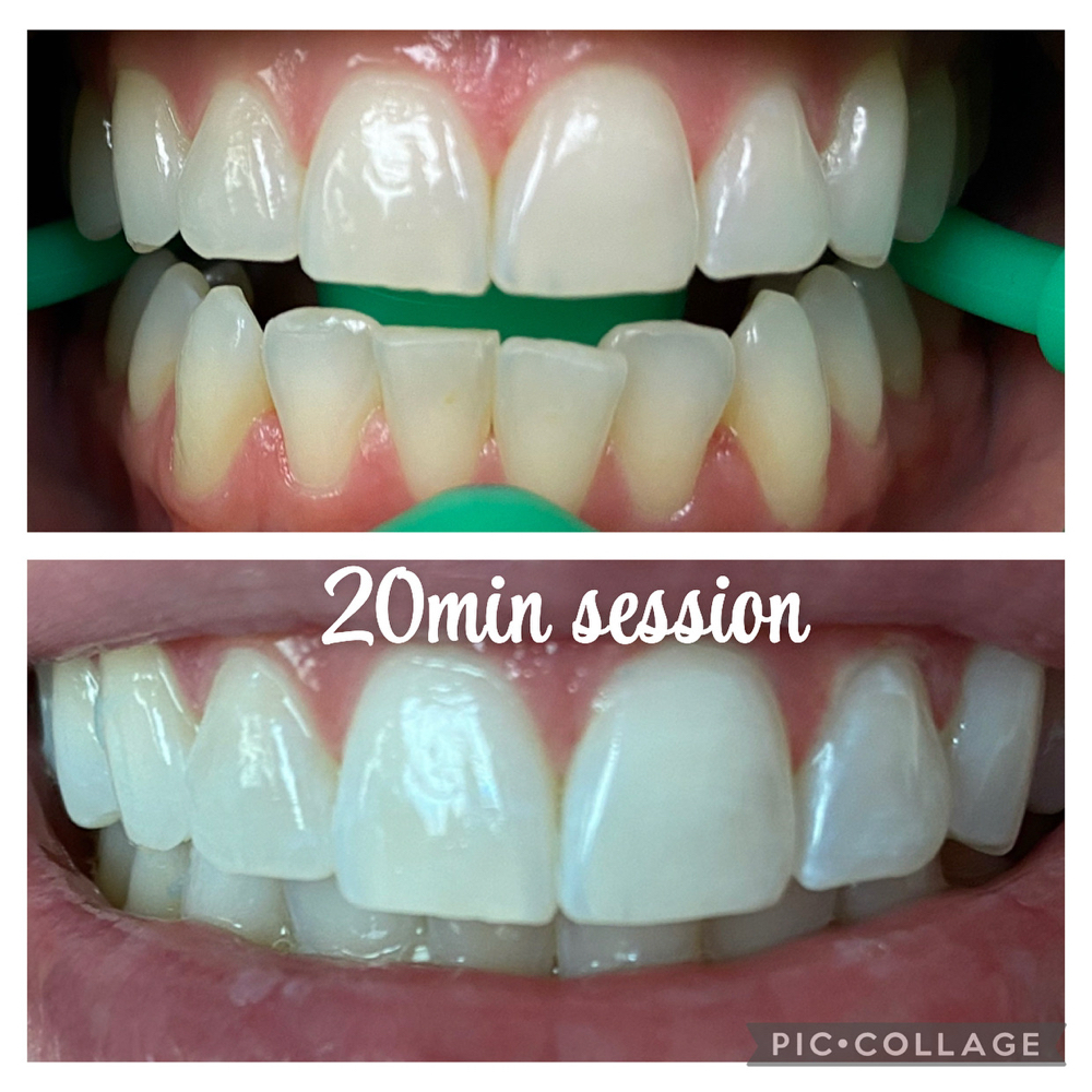 40 Min Teeth Whitening