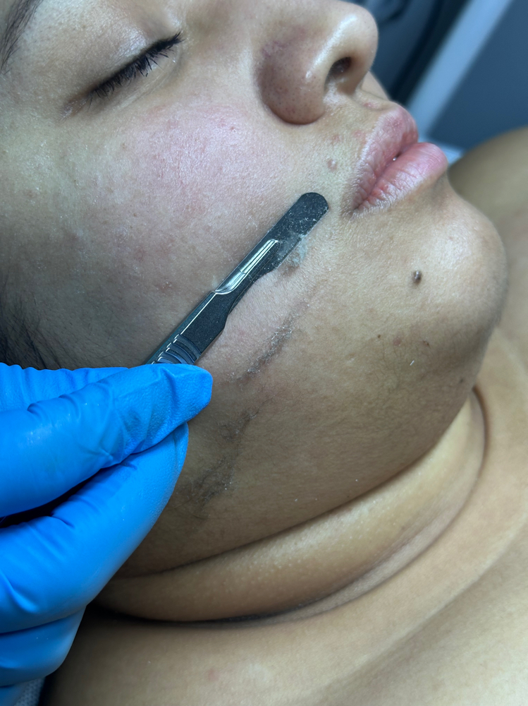 Dermaplaning And Deep Facial VIP