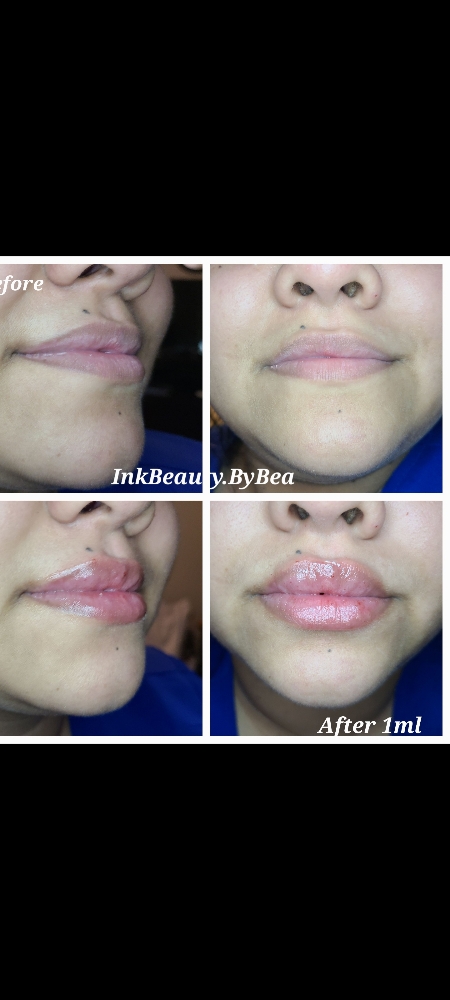 Lip Fillers: Lush Beauty Lip