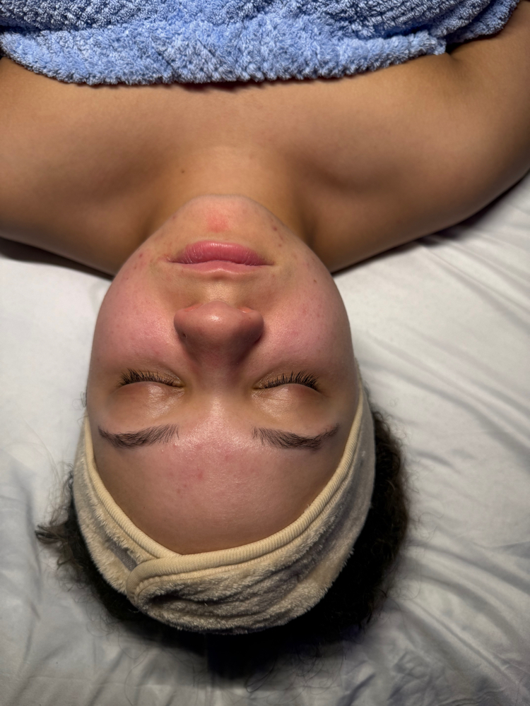 Chemical Peels