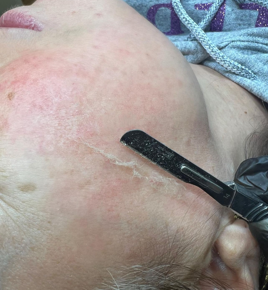 Dermaplaning