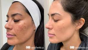 Microneedling & Chemical Peel