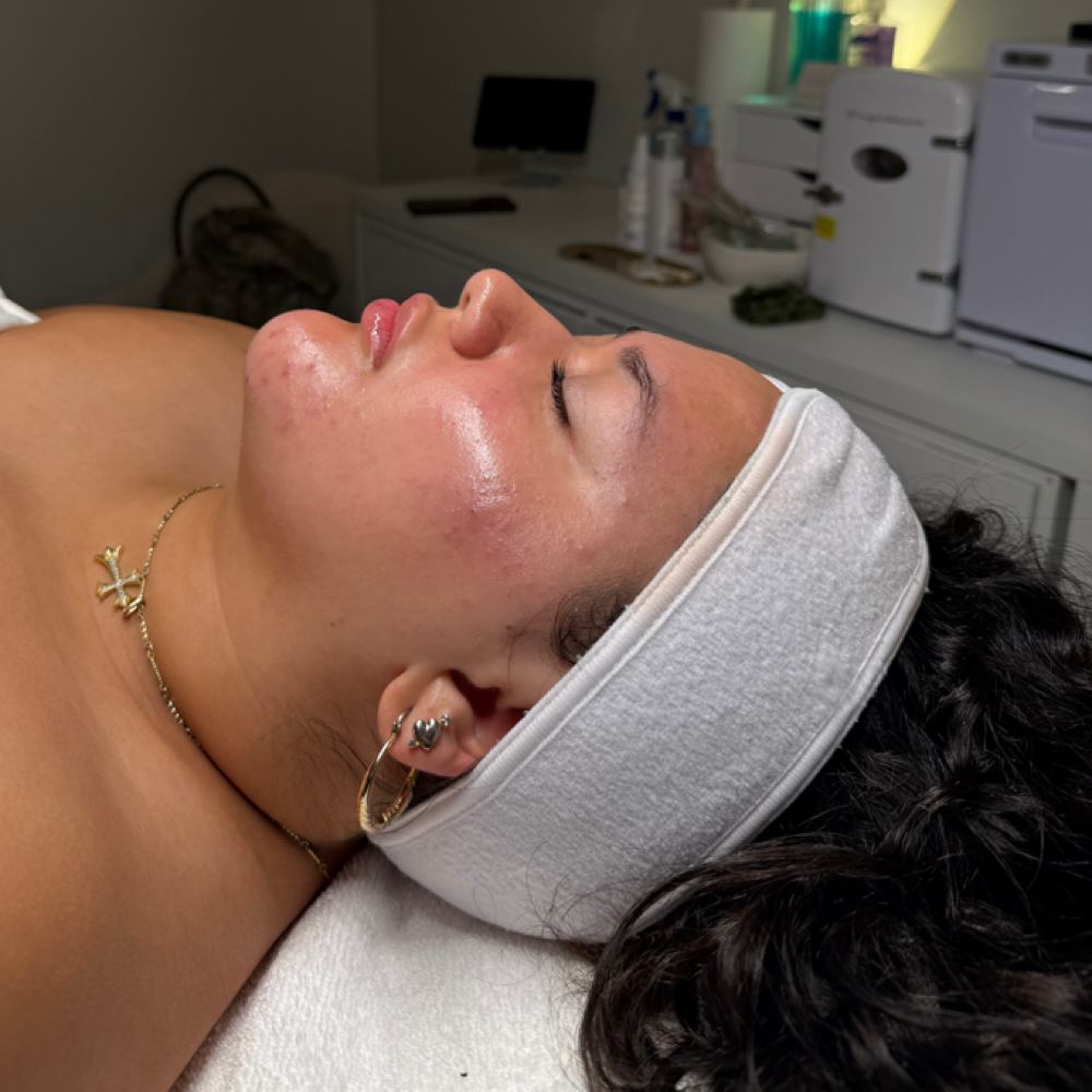 Microneedling + Chemical Peel at SKNFORM in Phoenix, AZ