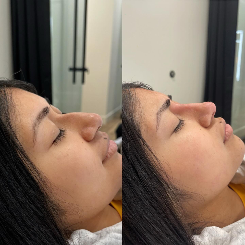 Non Surgical Rhinoplasty at Lips And Hips Beauty Bar in Modesto, CA