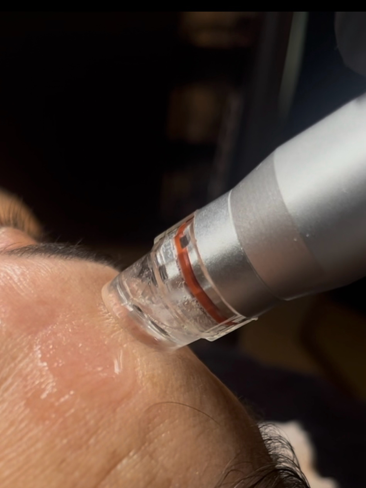 Hydrodermabrasion Facial
