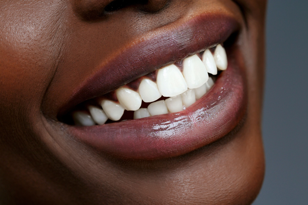 Classic Teeth Whitening