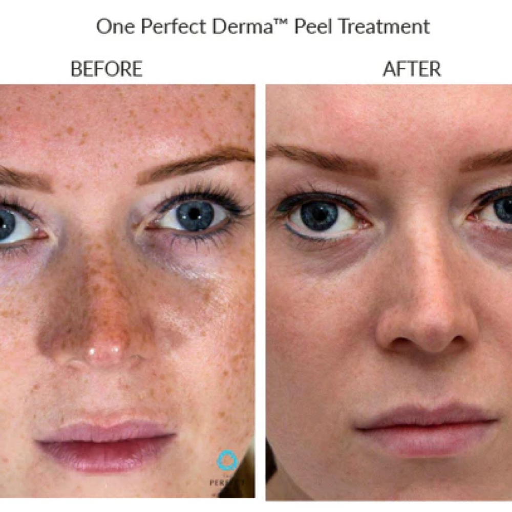 Perfect Derma Peel at Dawn Esthetics in Colorado Springs, CO