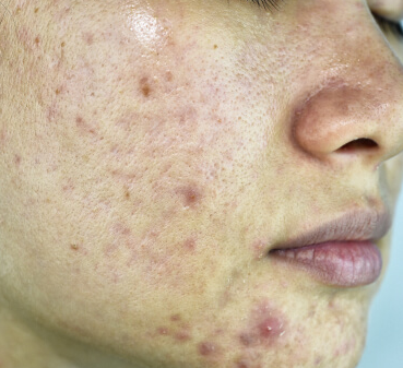 Acne | Scar Facial Treatment