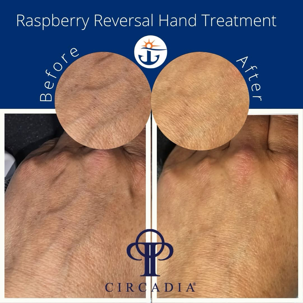 Anti-aging Hand Treatment