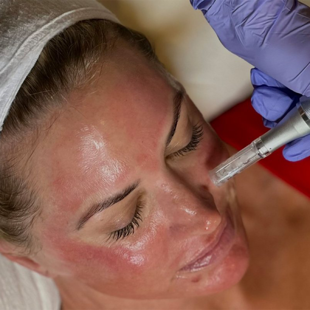 Microneedling at Aura Beauty Lounge LLC in Eagle, ID