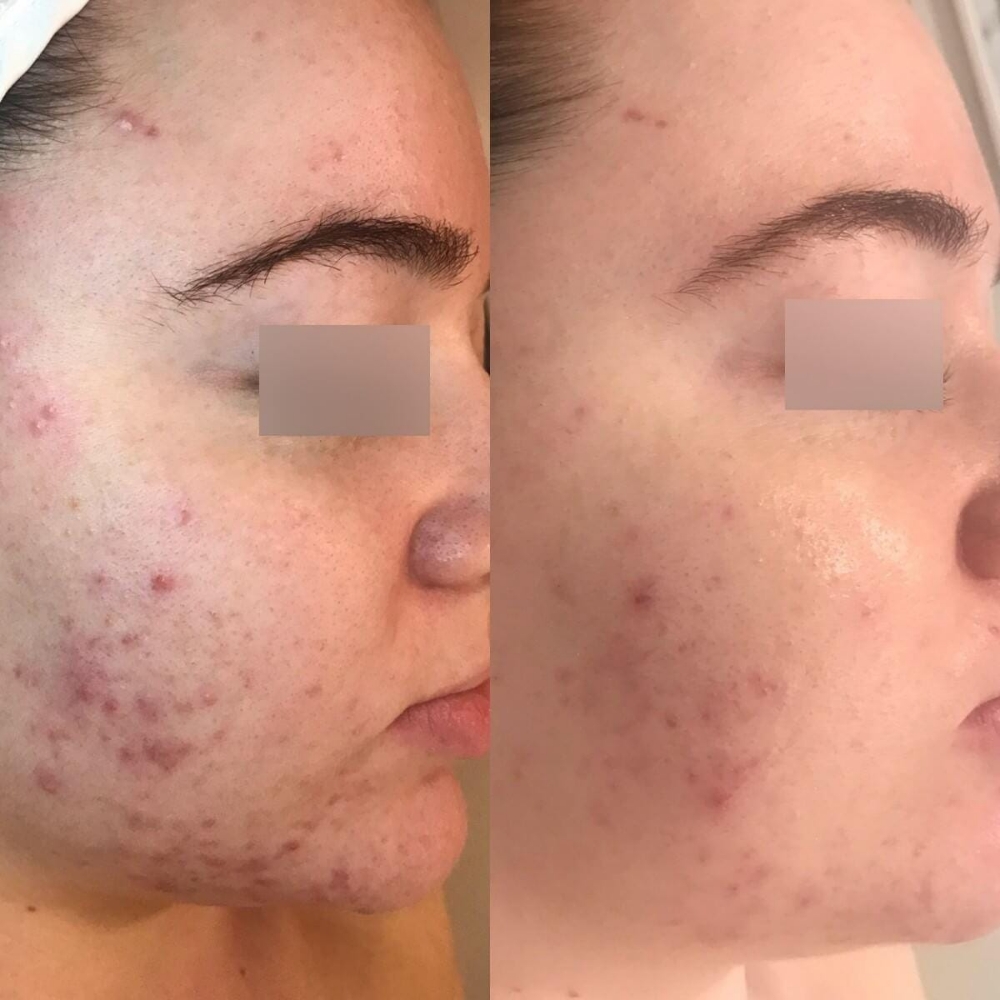 R&B Acne Treatment