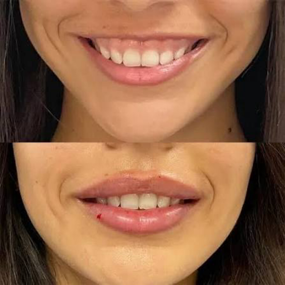 Mothers Day Lip Flip Sale at All Aesthetics Kare in Upland, CA