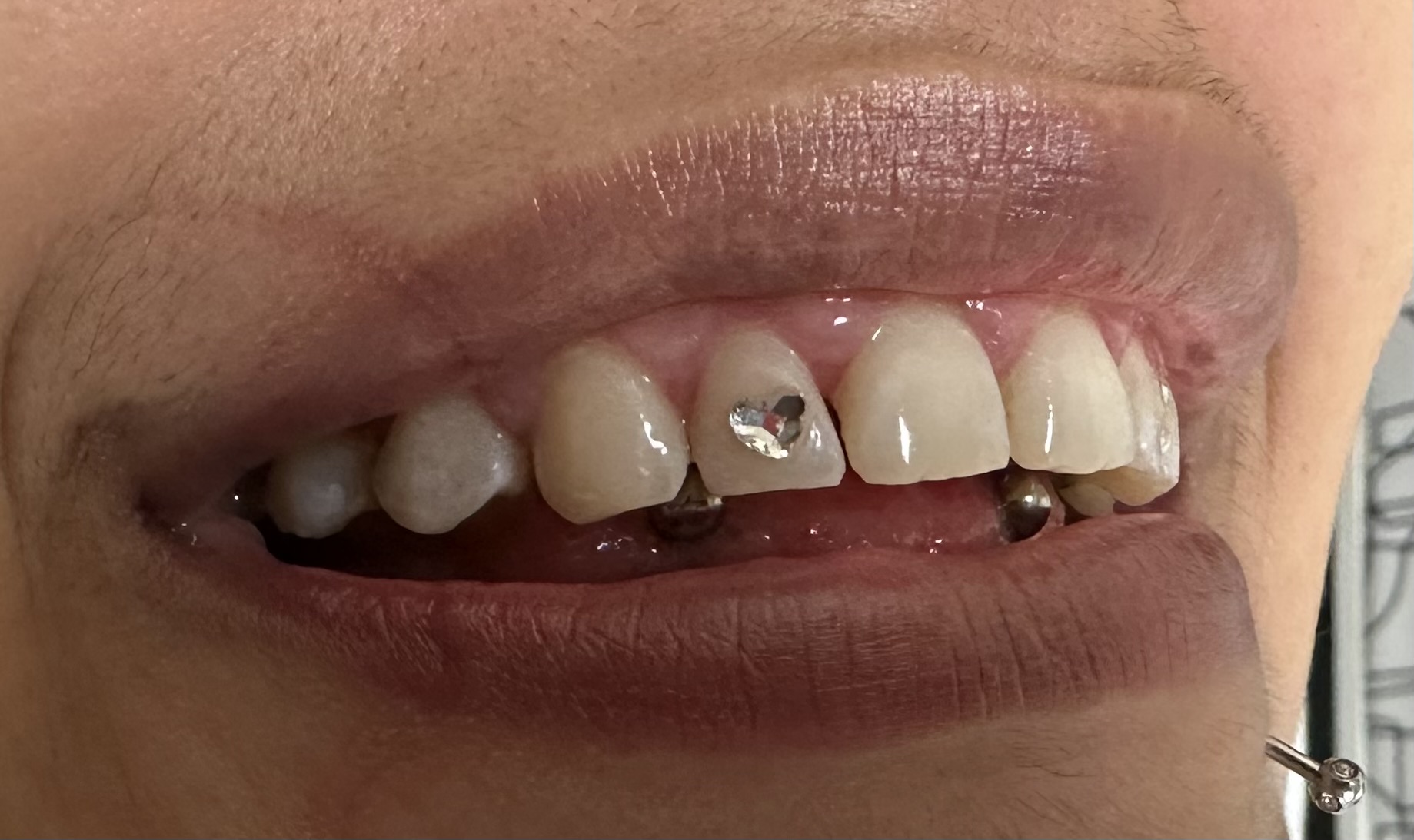 1 Tooth Gem