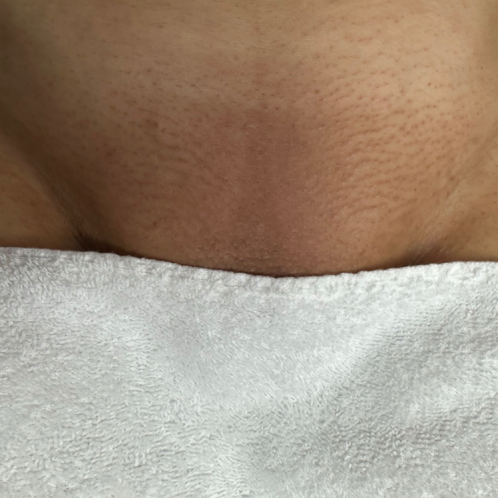 Deluxe Brazilian Wax & Vajaical at ACESTHETICS LLC in Milford, CT