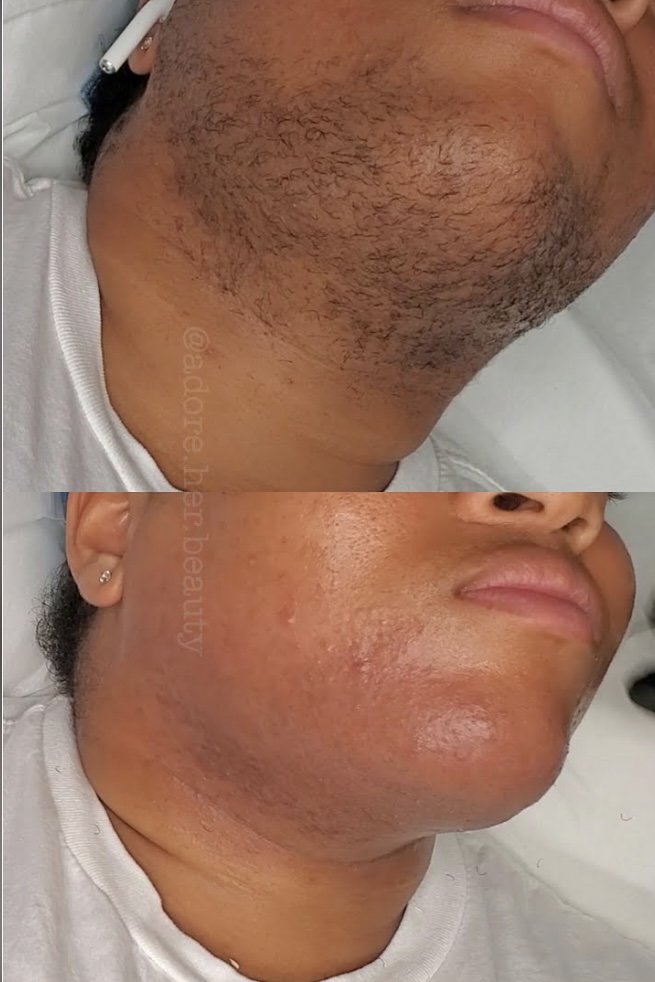 Chin Wax