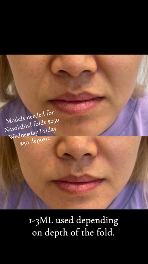 Nasal Labial Filler