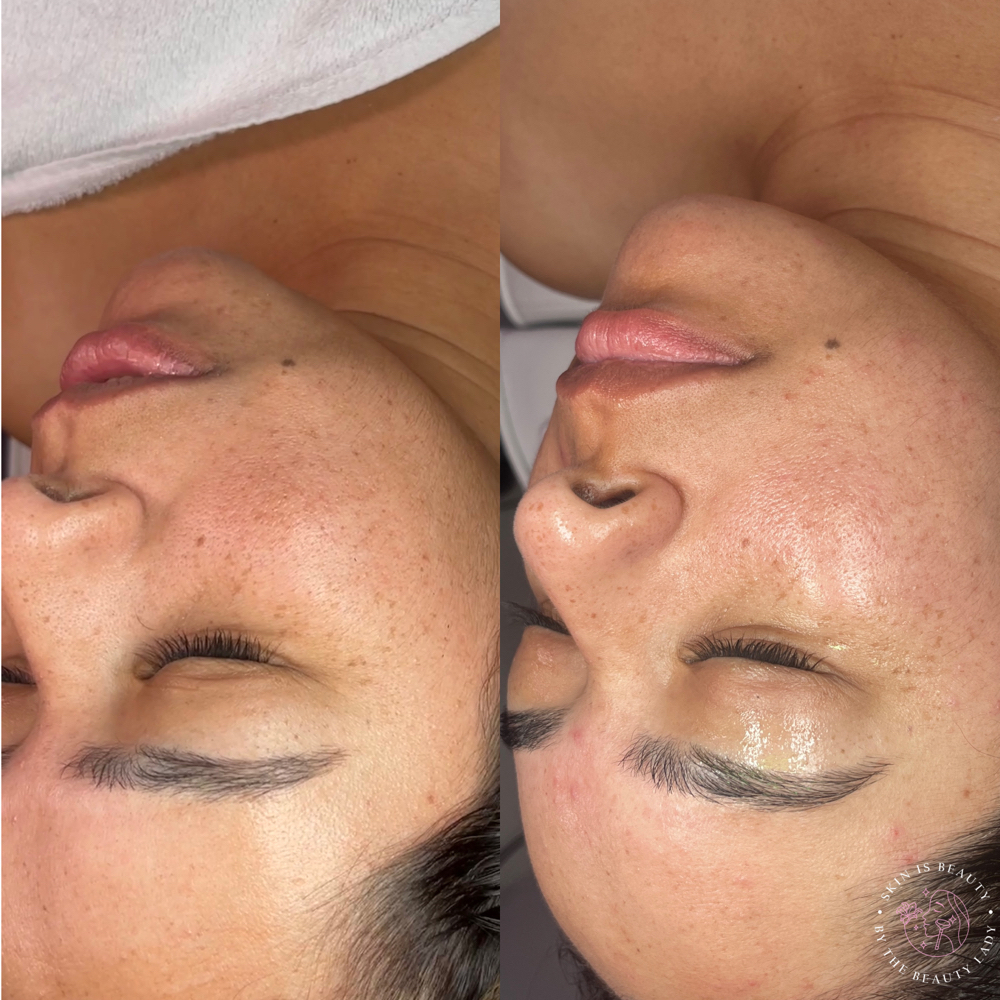 Microdermabrasion