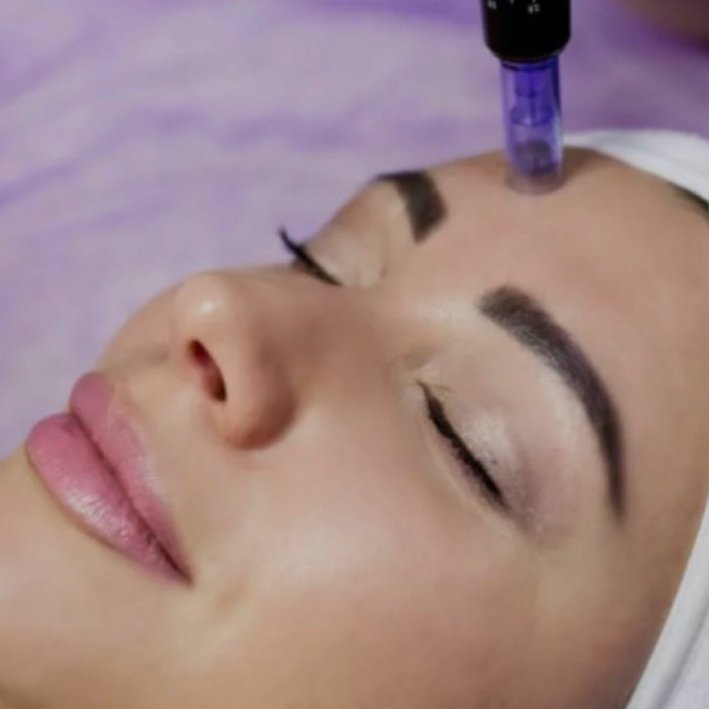 PRF Microneedling at Graceful Skin Aesthetics LLC in Glendale, AZ