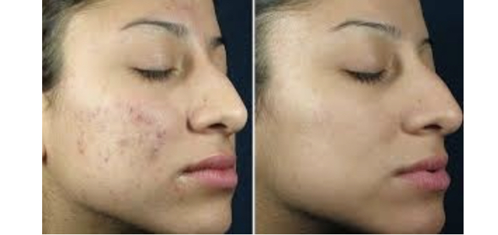 Chemical Peel + Dermaplane