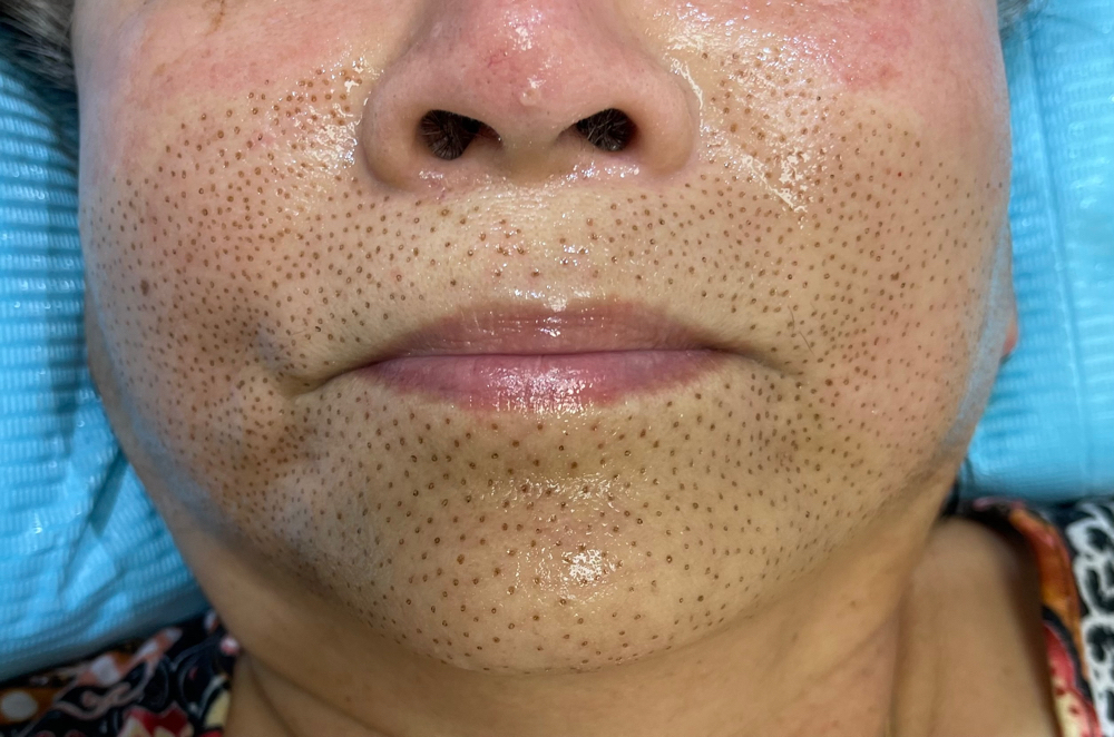 Lower FaceLift