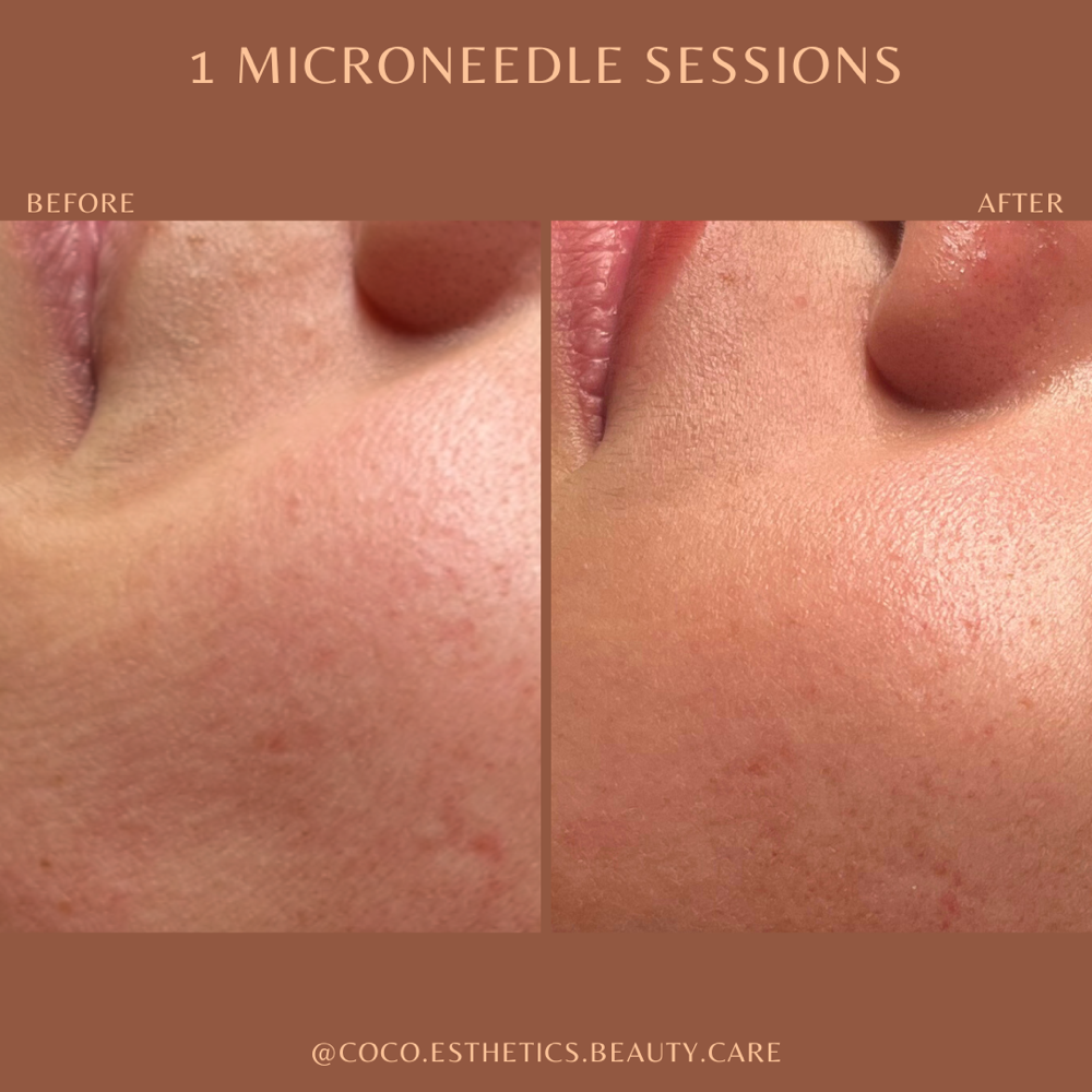 Microneedle
