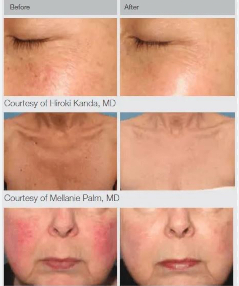 IPL ( Intense Pulsed Light)
