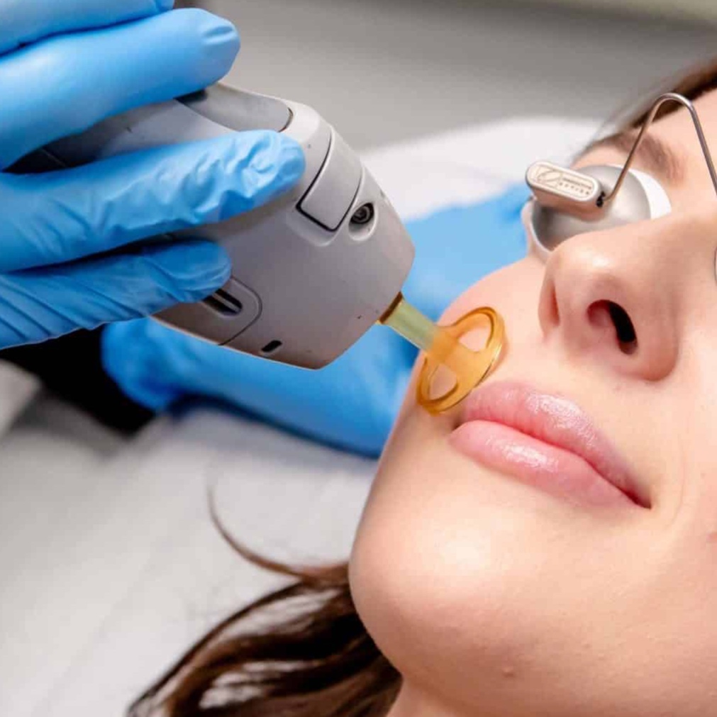 Laser Hair Removal Small Area