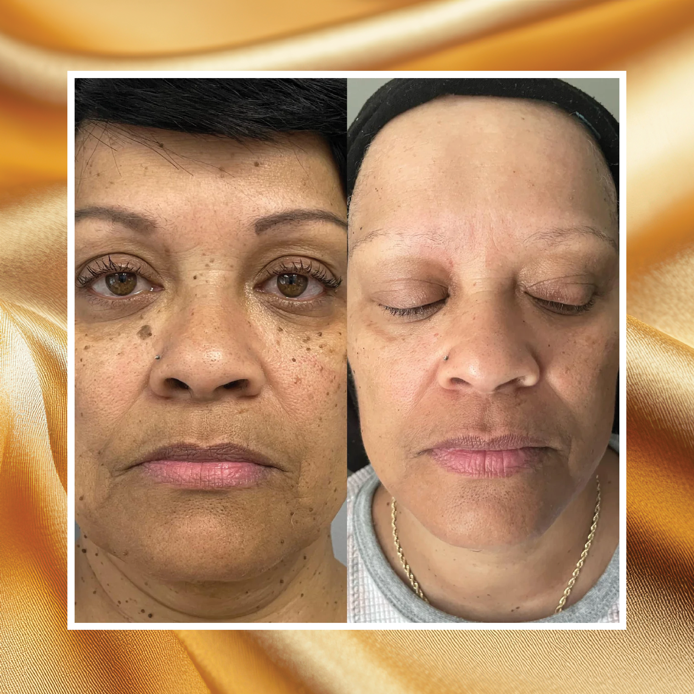 DPN, Skin Tag & SK Treatment -30min