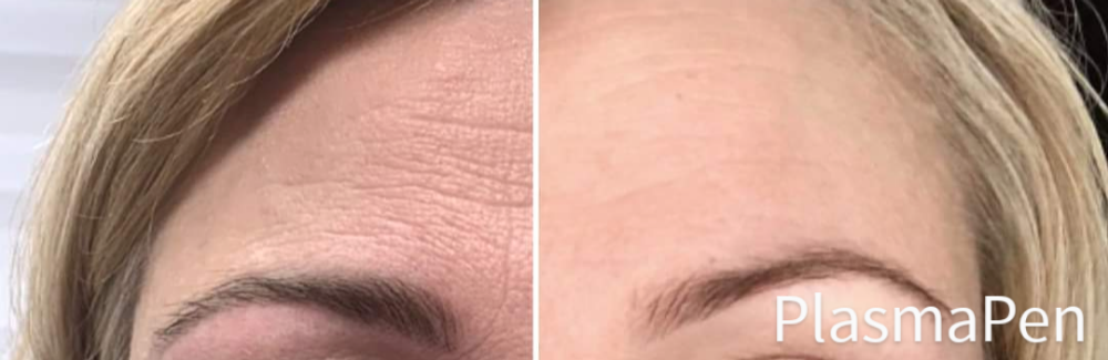 Forehead Lift & Worry Lines