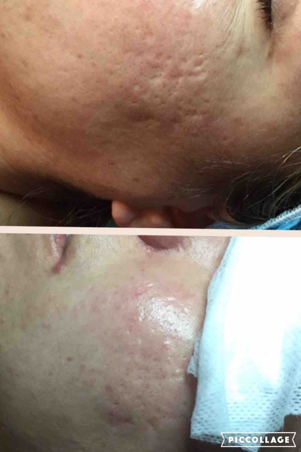 Microneedling