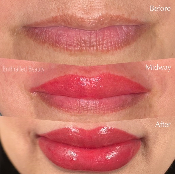 Lip Correction/Neutralization