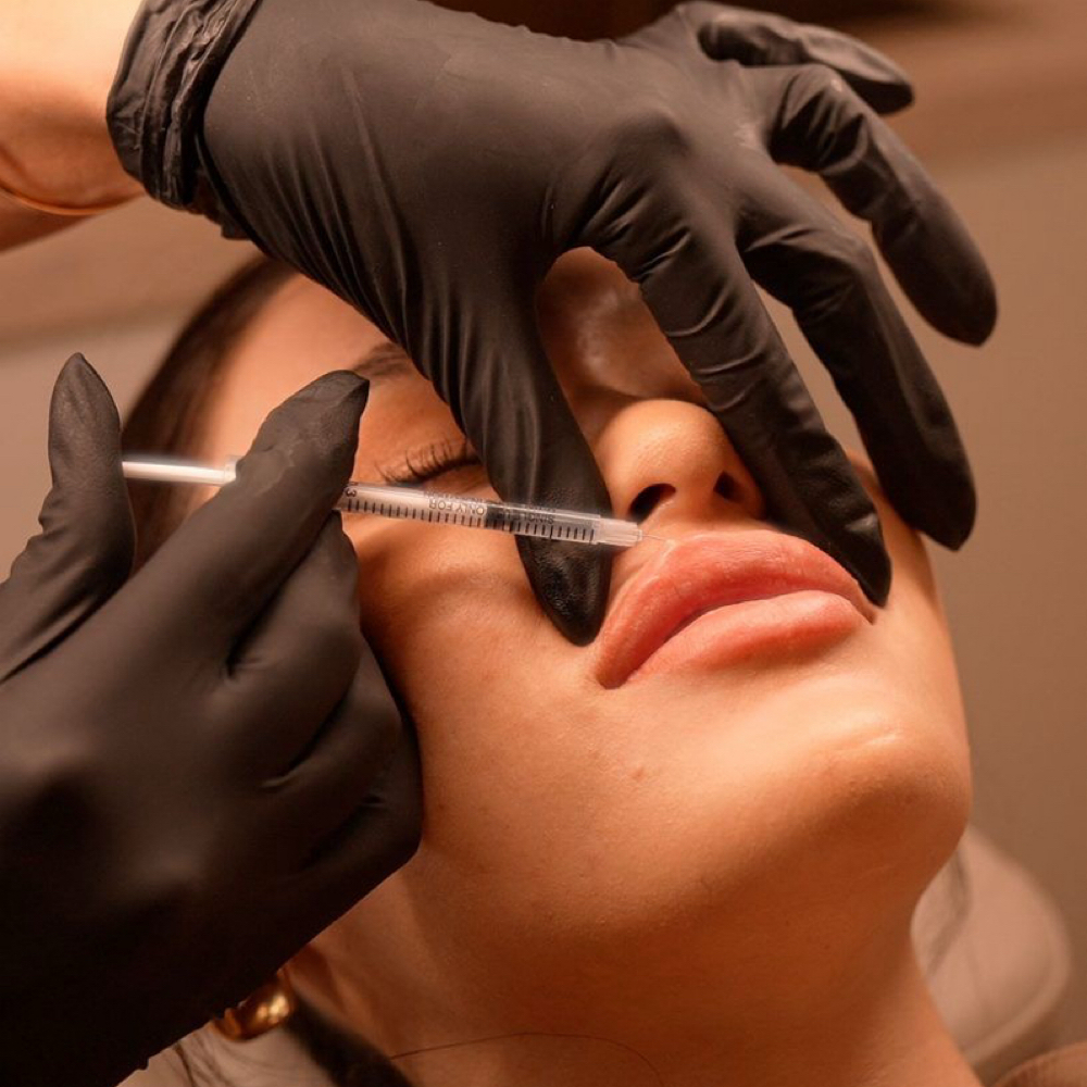 Lip Filler .5ml at Bare Aesthetics ATX in Austin, TX