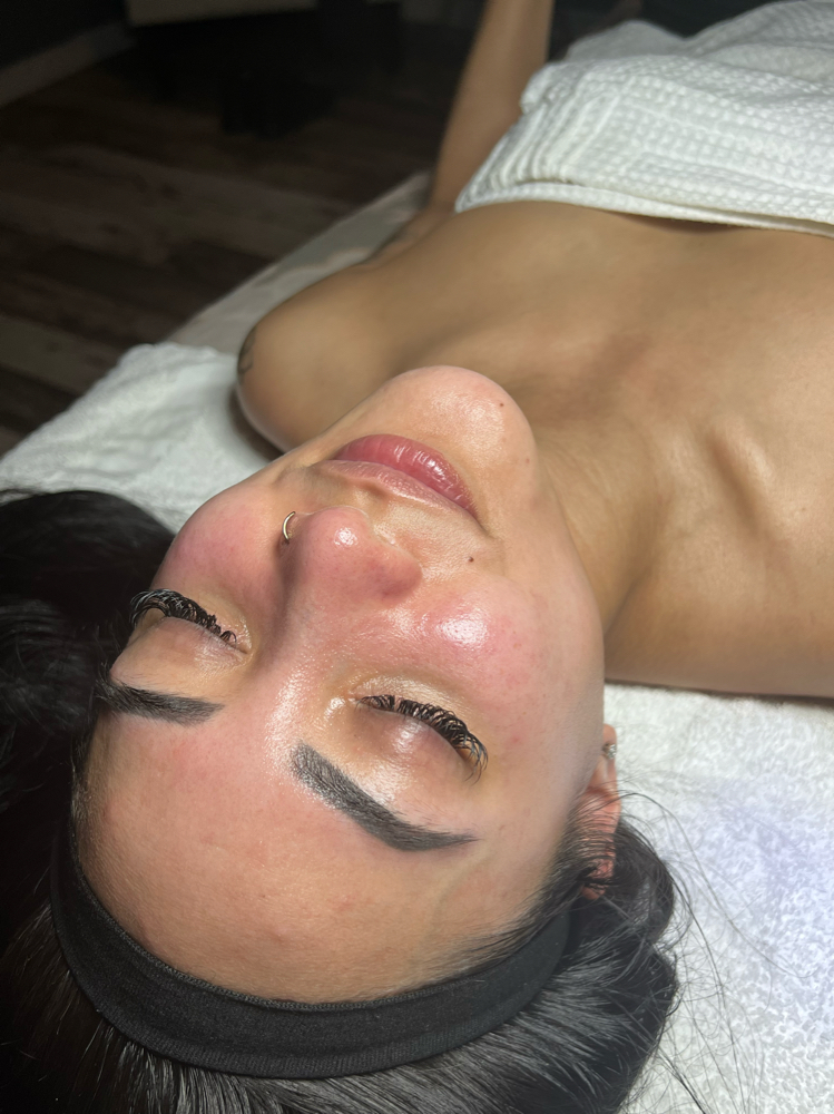 Hydrodermabrasion Facial