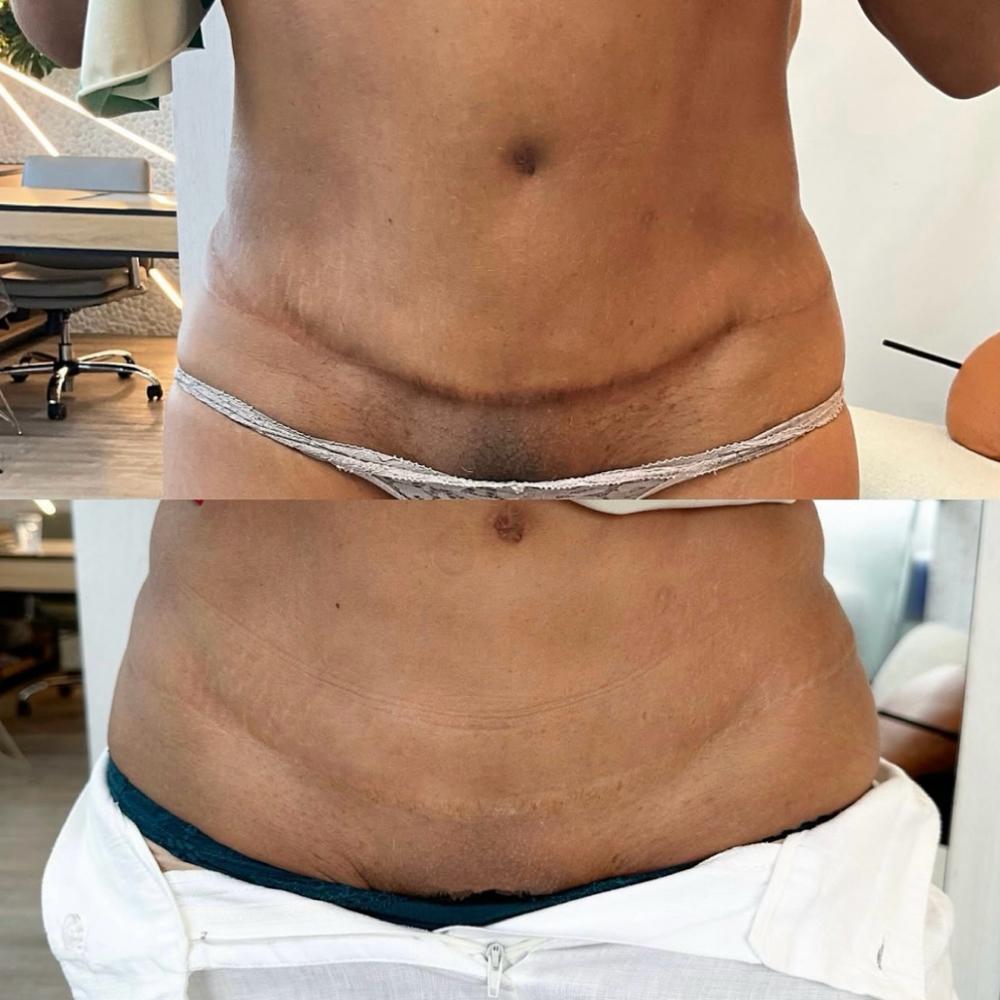 SKIN CAMOUFLAGE FREE CONSULTATION at Nuvi Beauty Bar in New York, NY