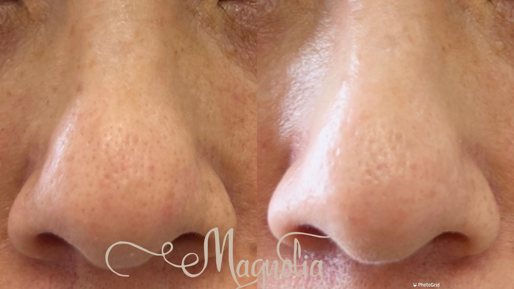 Nose Contouring