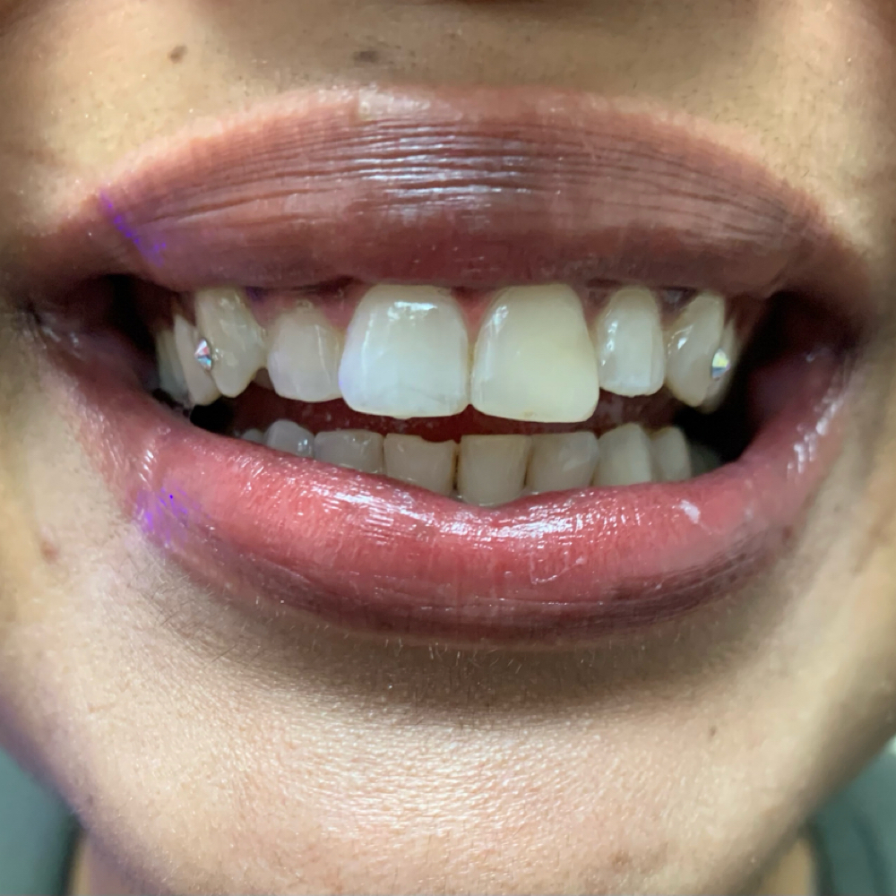 Swarovski Tooth Gems at Icey Bodies in St Anthony, MN