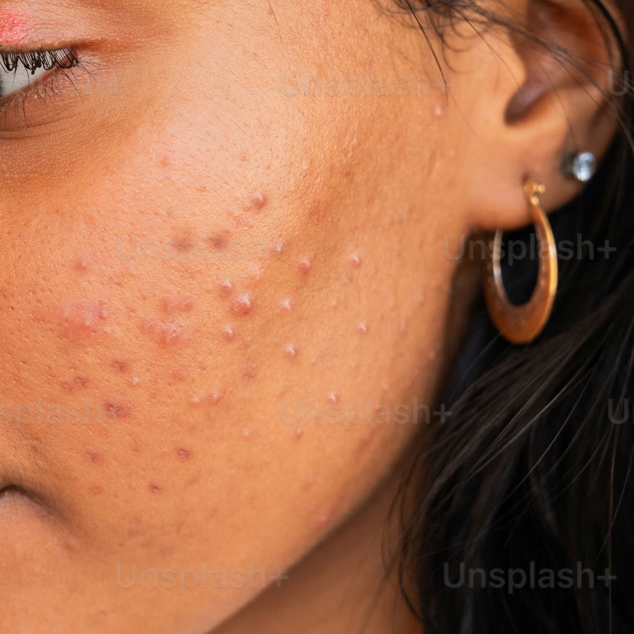Mini Acne Facial at D’Olive Skin Therapy in League City, TX