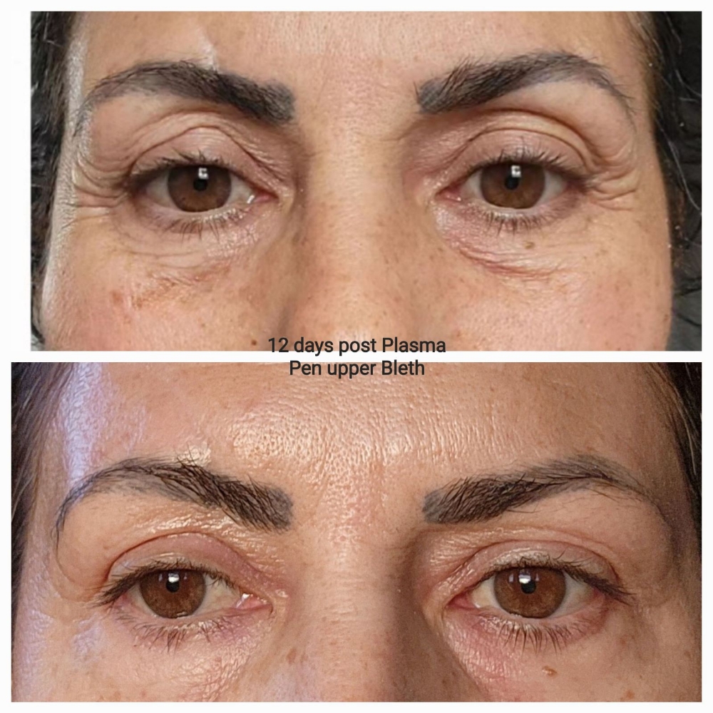 Plasma PEN Fibroblast  FOXEYE LIFT