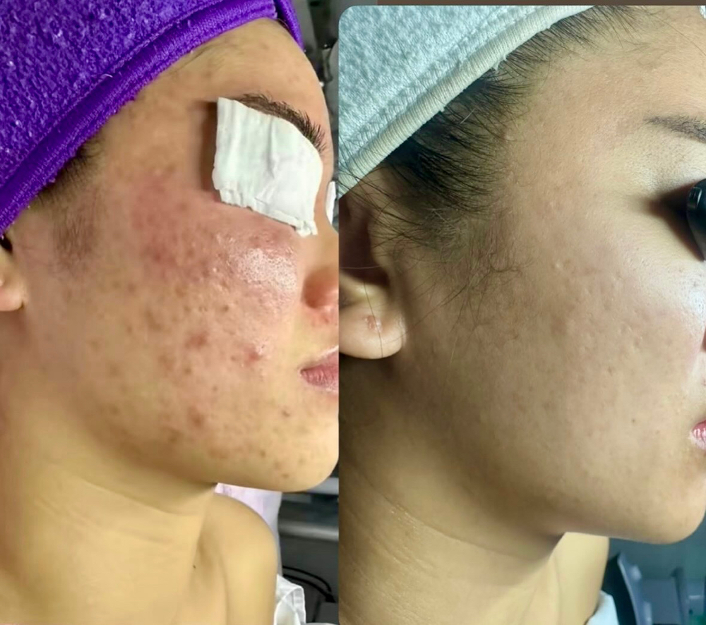 Purifying Acne Facial