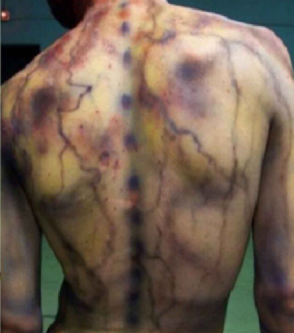 Fibromyalgia Lymphatic Drainage