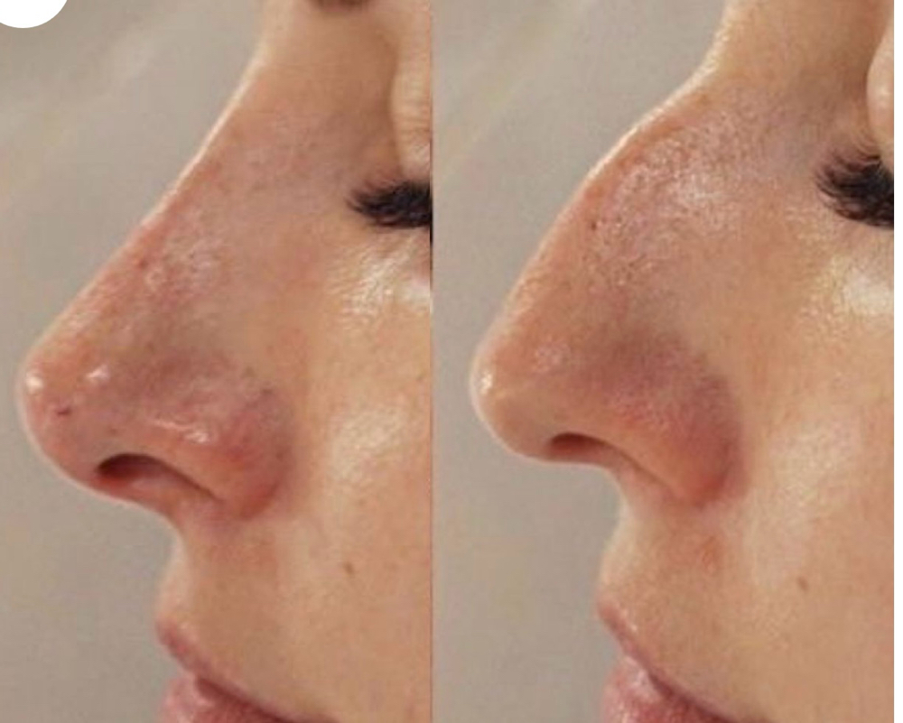Non-Surgical Nose Reshaping