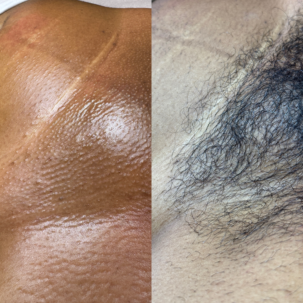 Brazilian Wax at Simply Gorgeous Esthetics in Downers Grove, IL