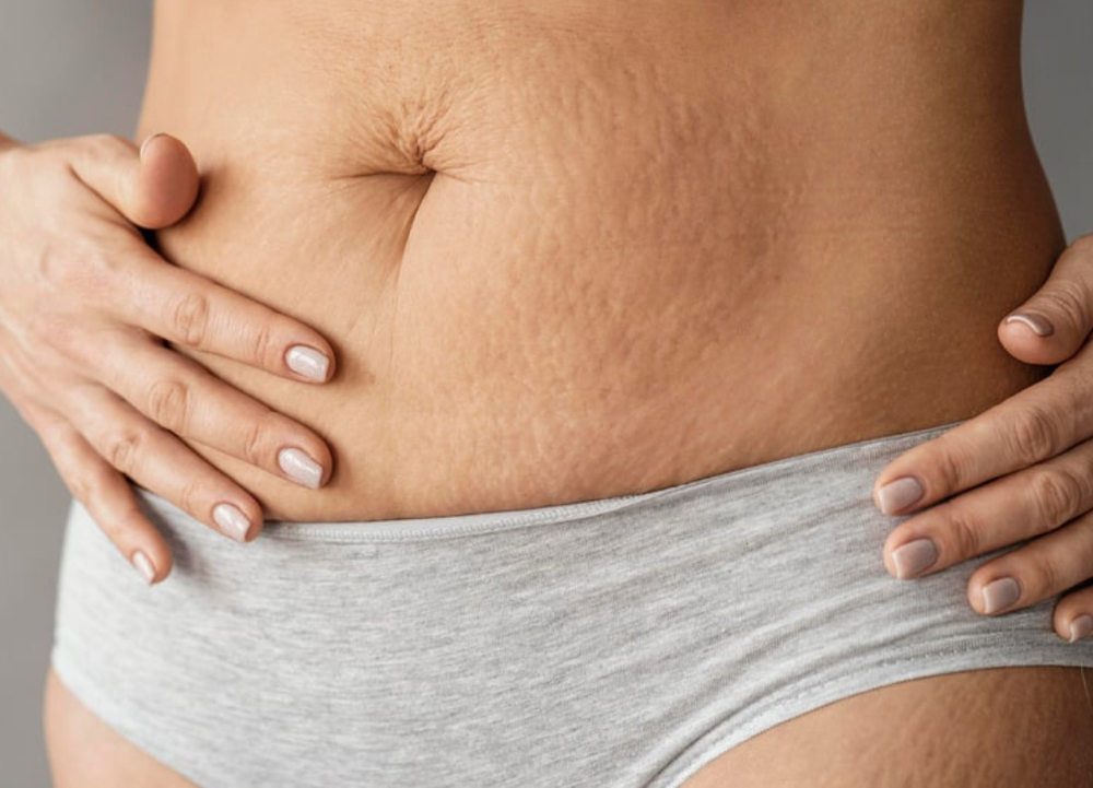 Stretch Mark Revision (Large Area)